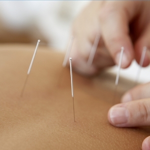 Acupuncture Treatment 3