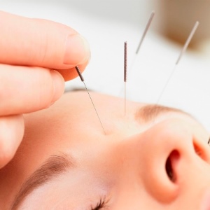 Acupuncture Treatment 1